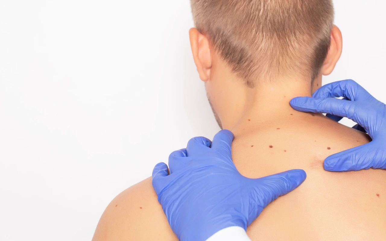 Fibromen verwijderen