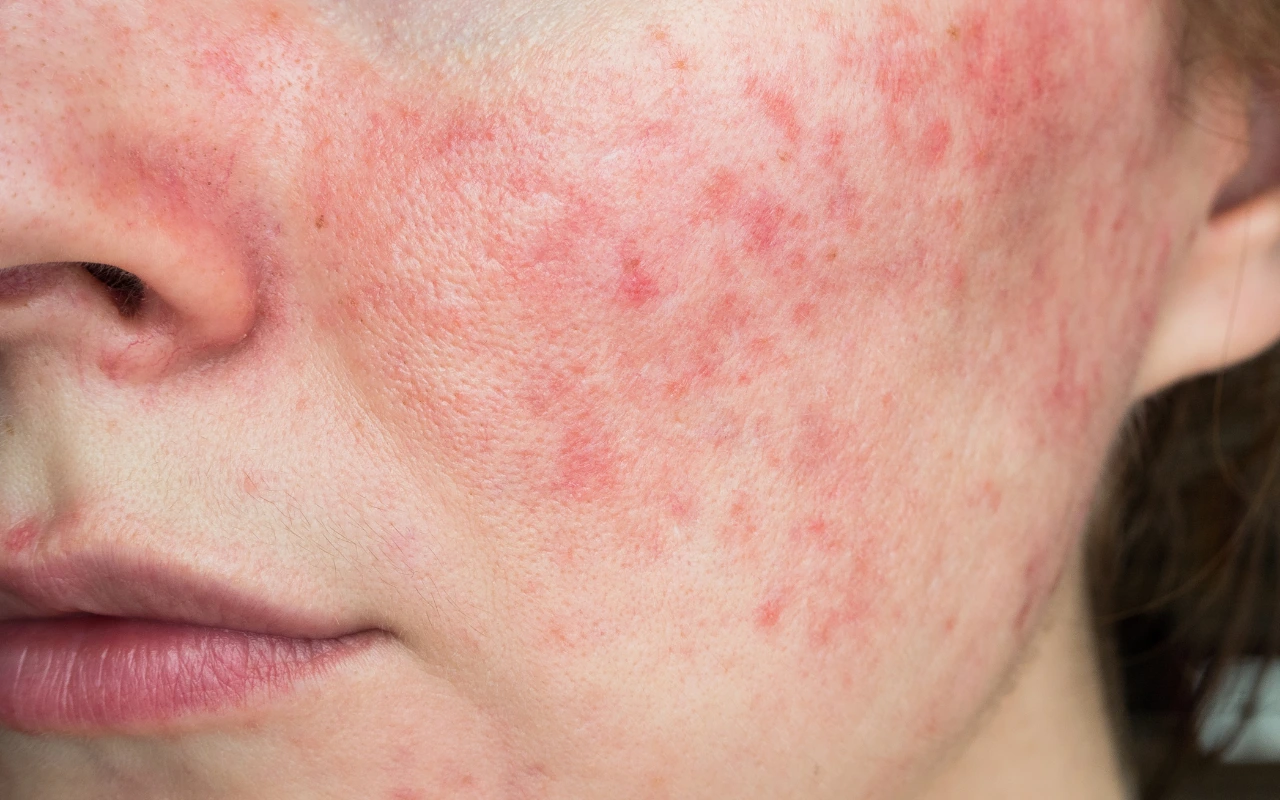 Rosacea behandeling