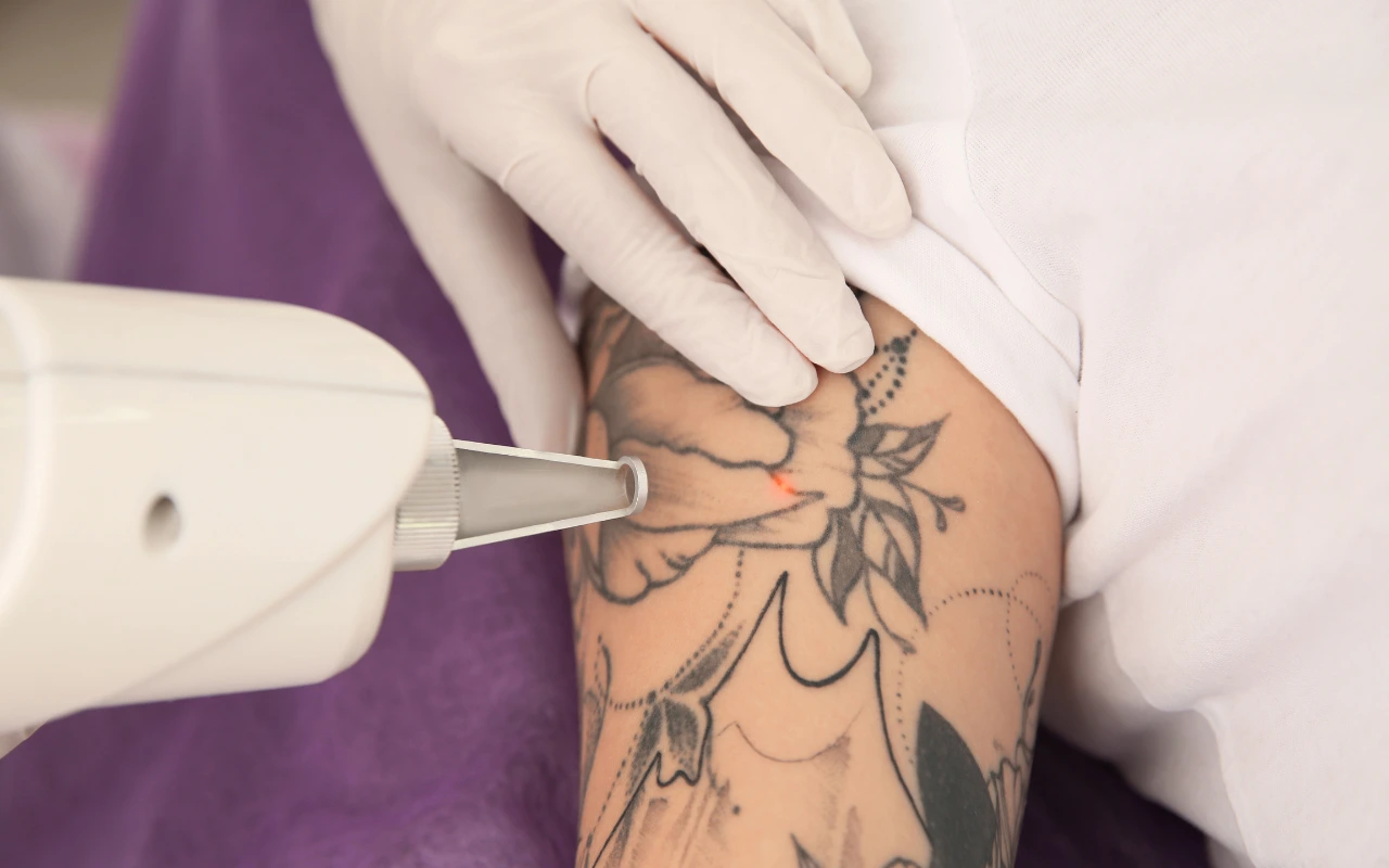 Tattoo verwijderen