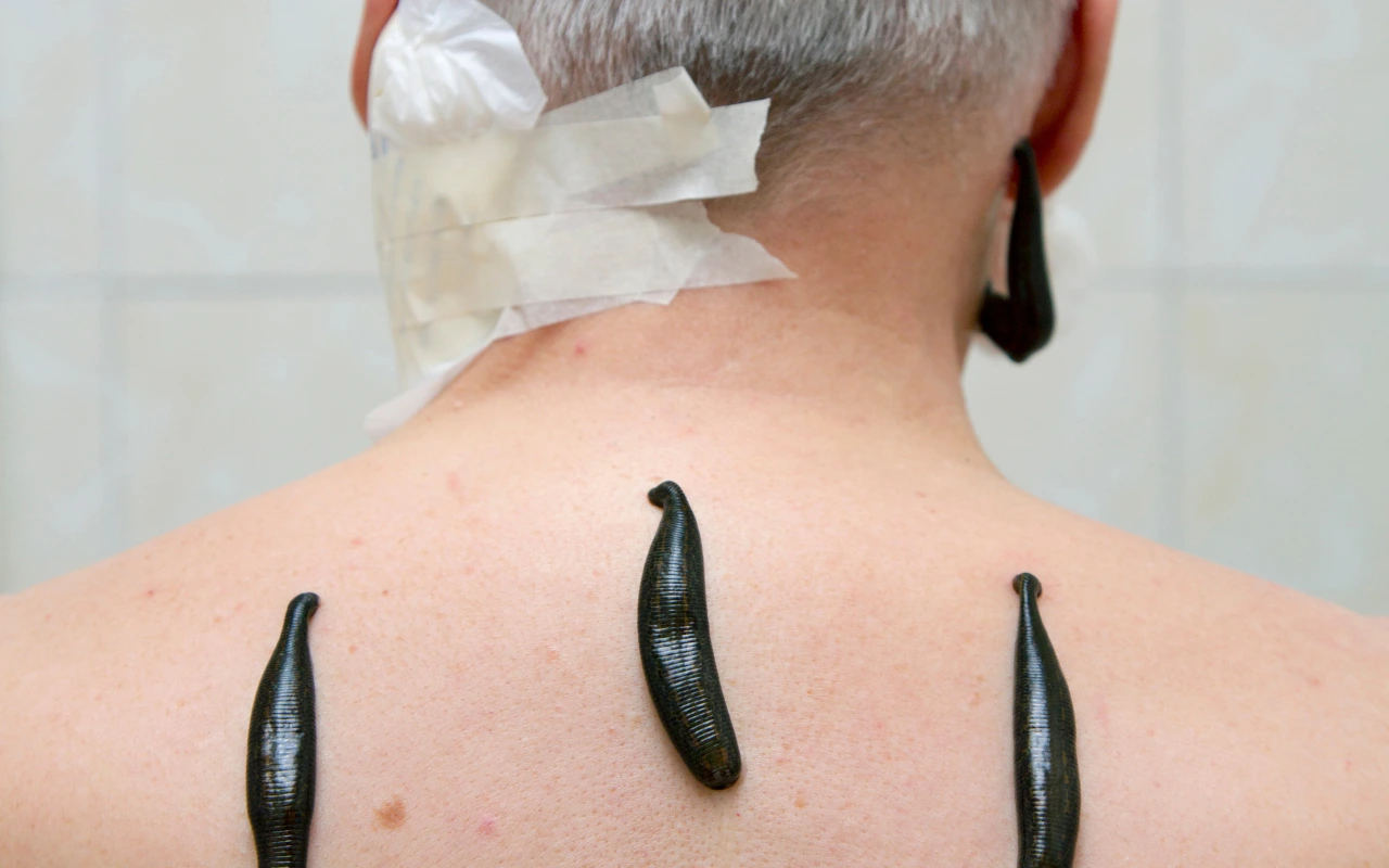migraine behandeling