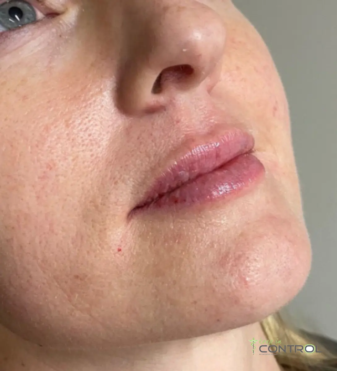 Fillers