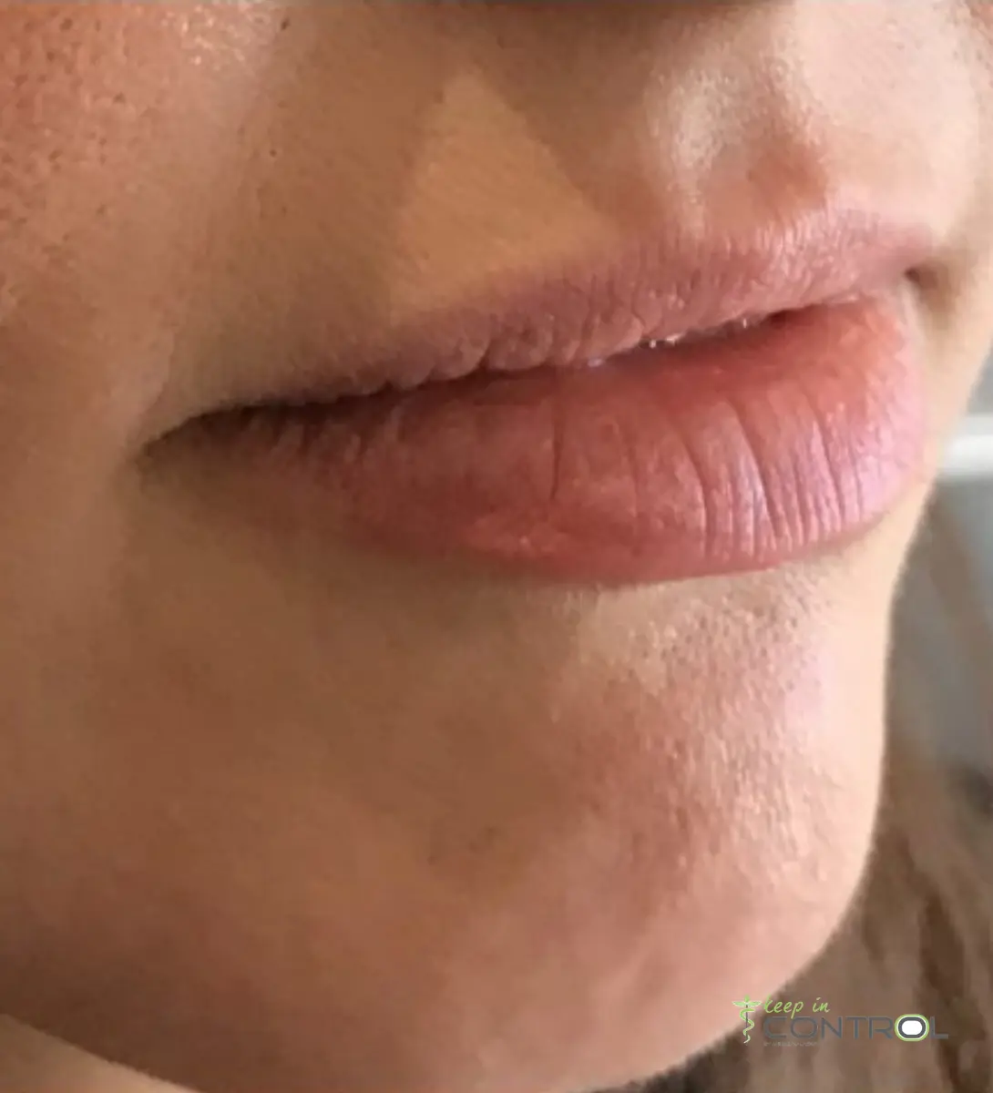 Fillers