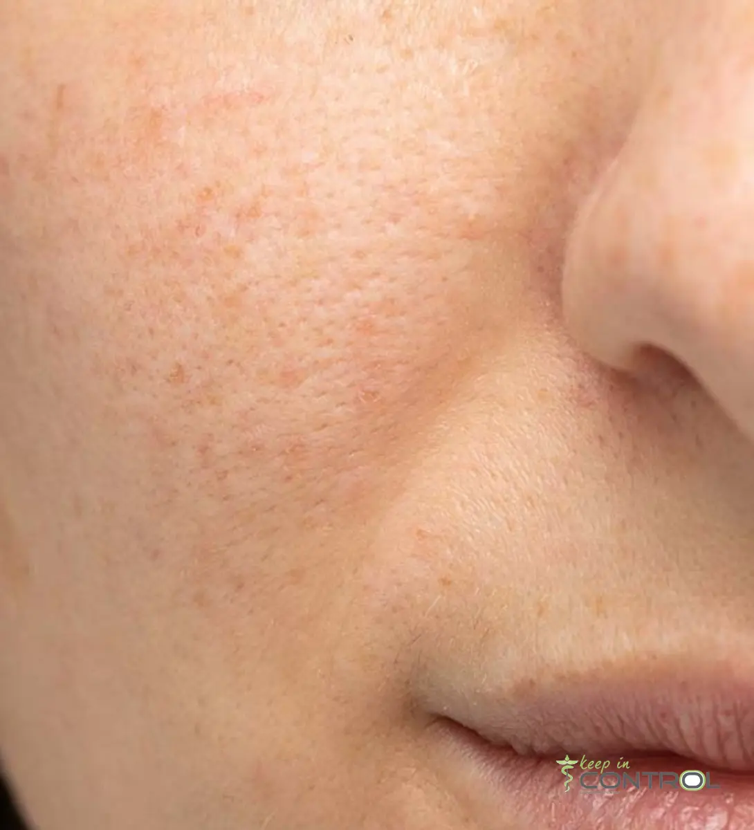 Rosacea behandeling