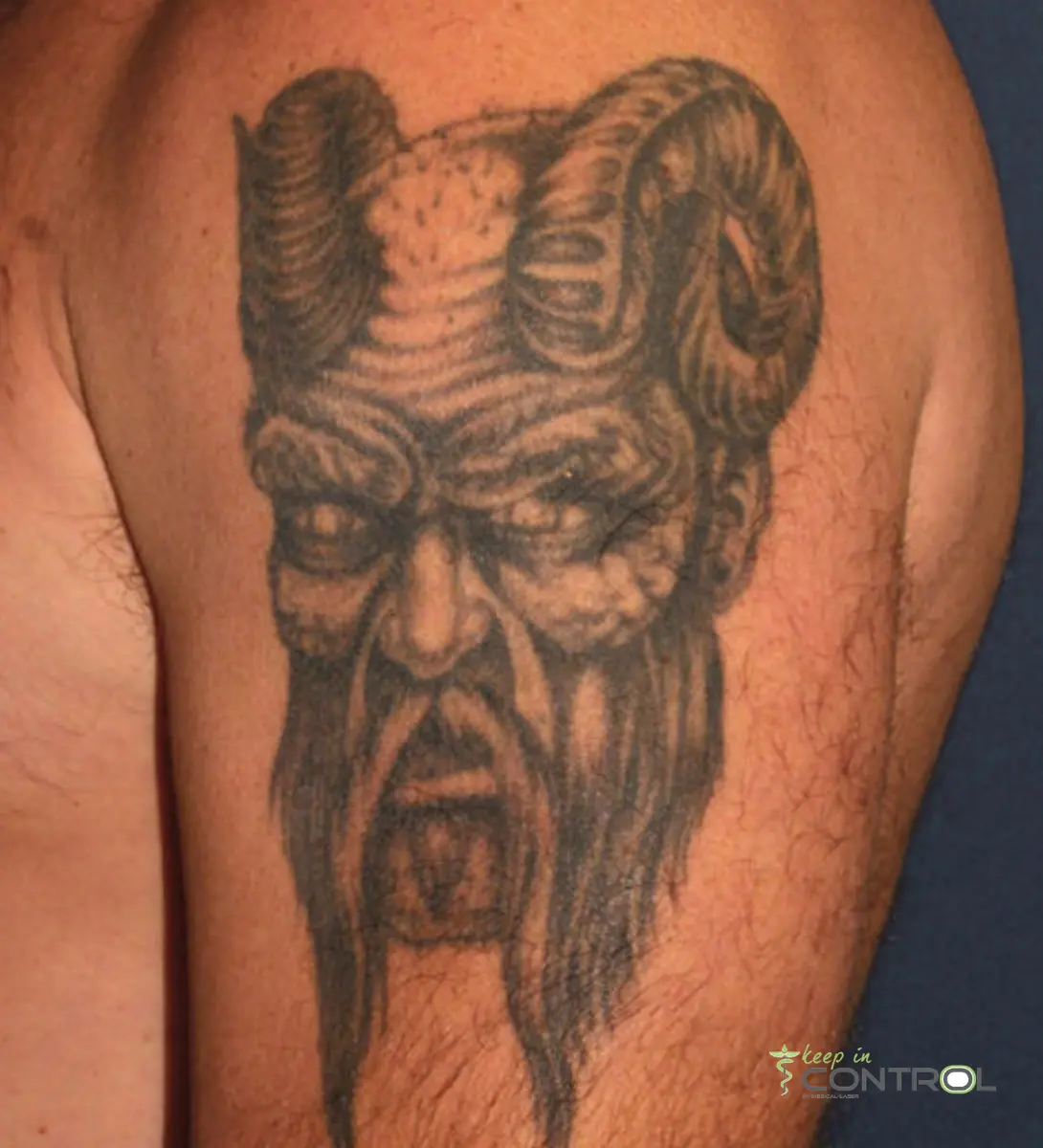 Tattoo verwijderen