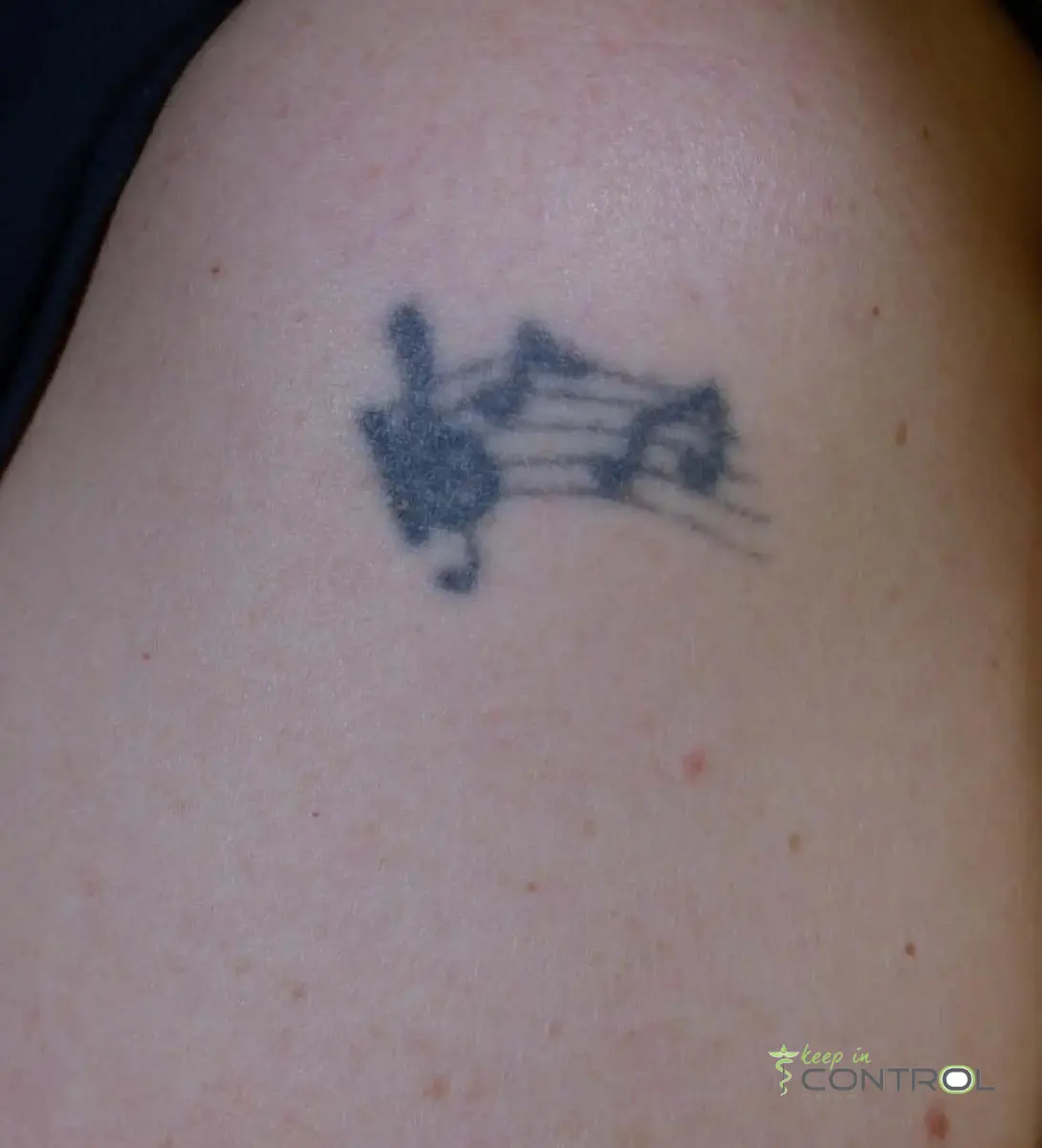 Tattoo verwijderen