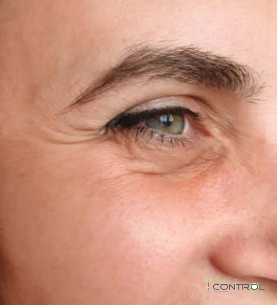 botox